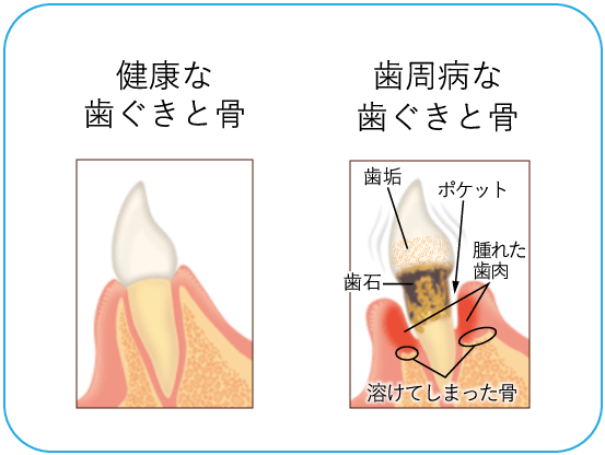 健康な歯ぐきと歯周病の歯ぐきと骨