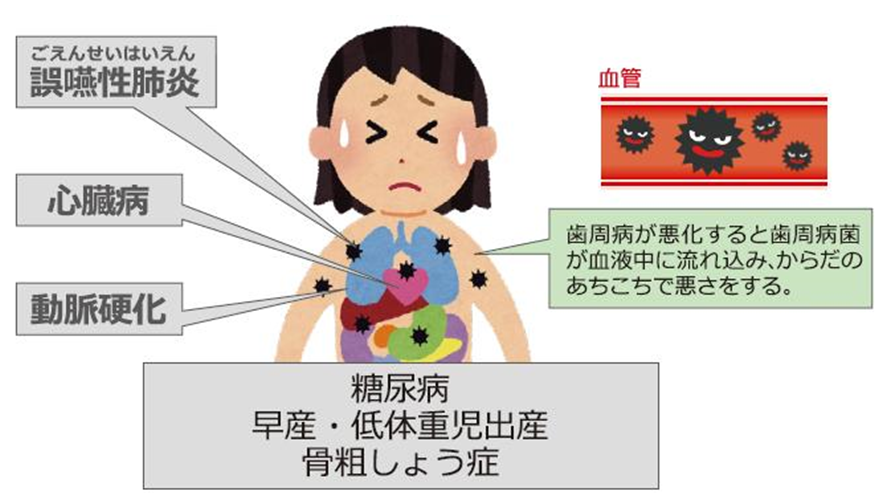 誤嚥性肺炎、心臓病、動脈硬化、糖尿病、早産・低体重児出産、骨粗しょう症、歯周病が悪化すると歯周病菌が血液中に流れ込み、からだのあちこちで悪さをする。