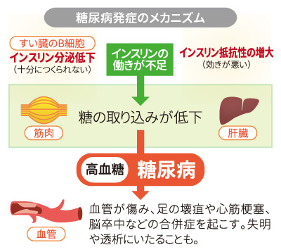 図:糖尿病発症のメカニズム