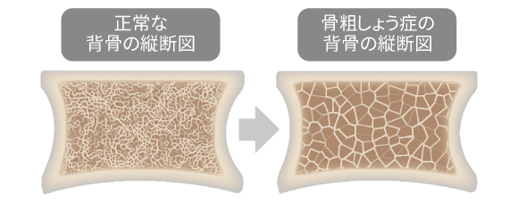 正常な背骨の断面図、骨粗しょう症の背骨の断面図