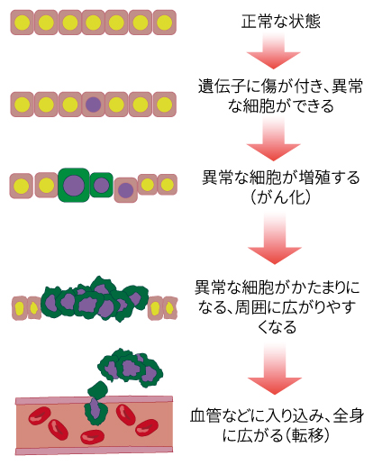(1)正常な状態(2)遺伝子に傷が付き、異常な細胞ができる(3)異常な細胞が増殖する(がん化)(4)異常な細胞がかたまりになる、周囲に広がりやすくなる(5)血管などに入り込み、全身に広がる(転移)