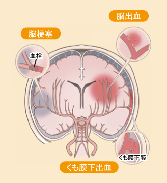 図:脳出血、脳梗塞(血栓)、くも膜下出血(くも膜下腔)