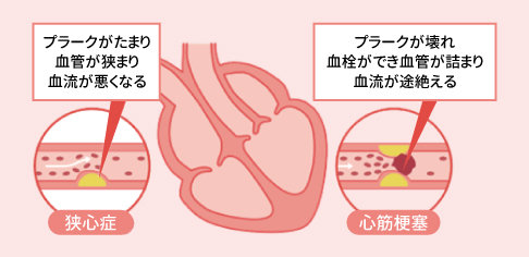 狭心症と心筋梗塞のイメージ画像